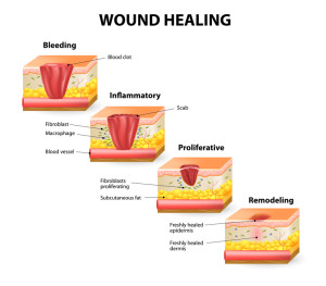 Wound healing